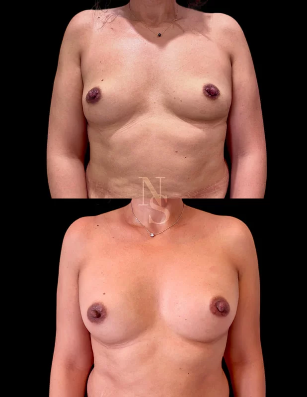 Résultats chirurgie esthétique avant après Dr Stroumza Paris