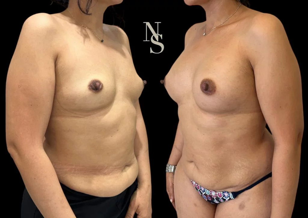 Résultats chirurgie esthétique avant après Dr Stroumza Paris