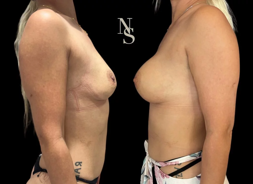 Résultats chirurgie esthétique avant après Dr Stroumza Paris