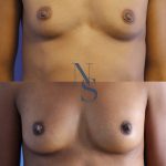 lipofilling-seins-2-face_4_orig.jpg