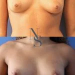 lipofilling-seins-3-face_4_orig.jpg