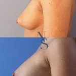 lipofilling-seins-3-profil_4_orig.jpg