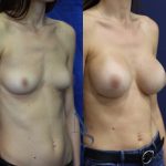 prothese-15-troisquart_3_orig.jpg