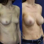 prothese-15-troisquart_3_orig.jpg