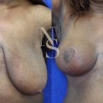 reduction-mammaire-2-face_6_orig.jpg