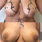 reduction-mammaire-4-face_6_orig.jpg