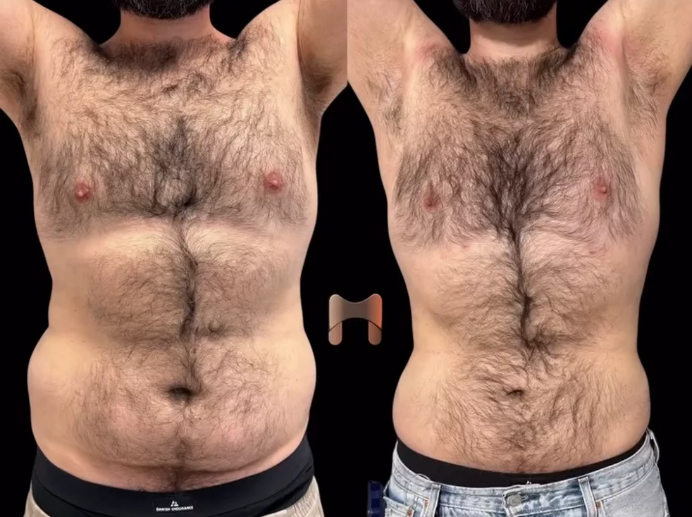 transformation abdominale sans cicatrice