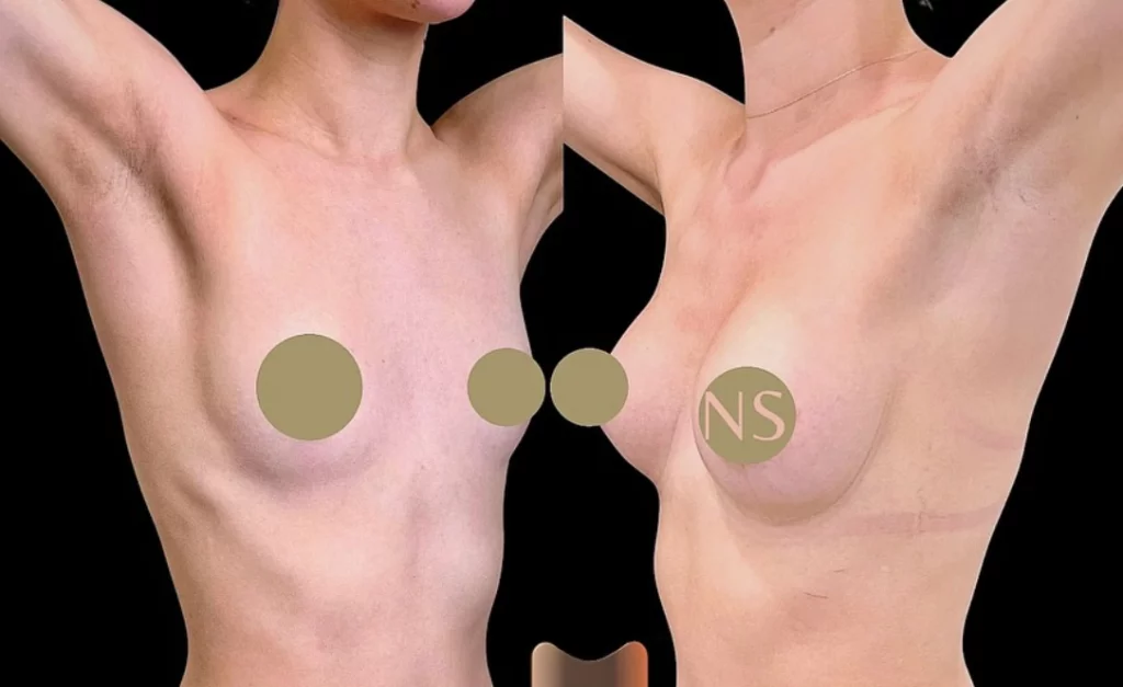 augmentation mammaire mini-invasive