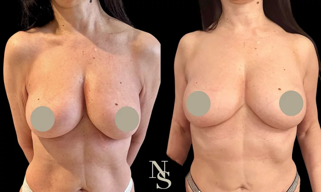 lifting mammaire mini-invasif