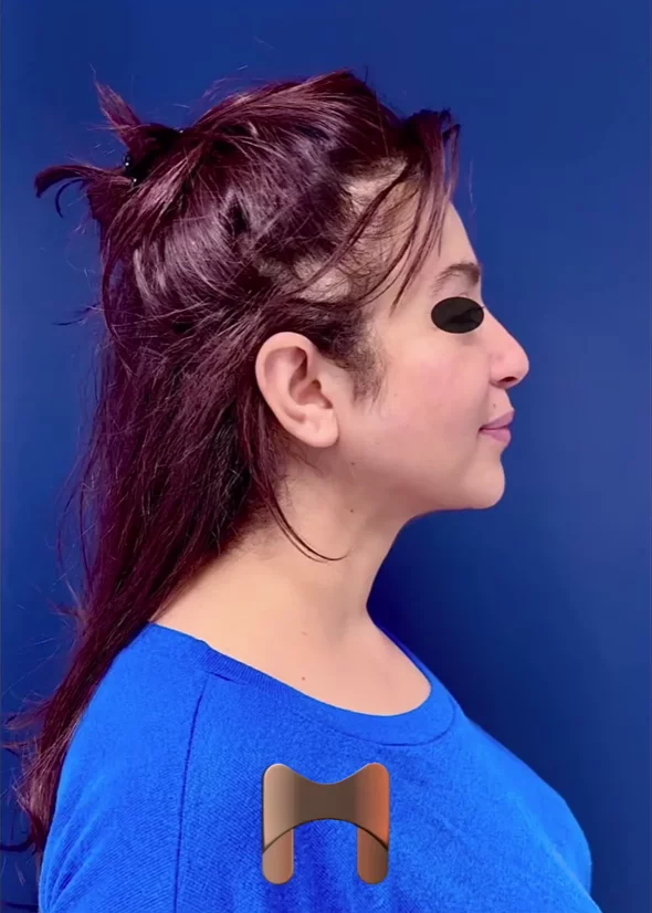 lifting du visage sans cicatrice