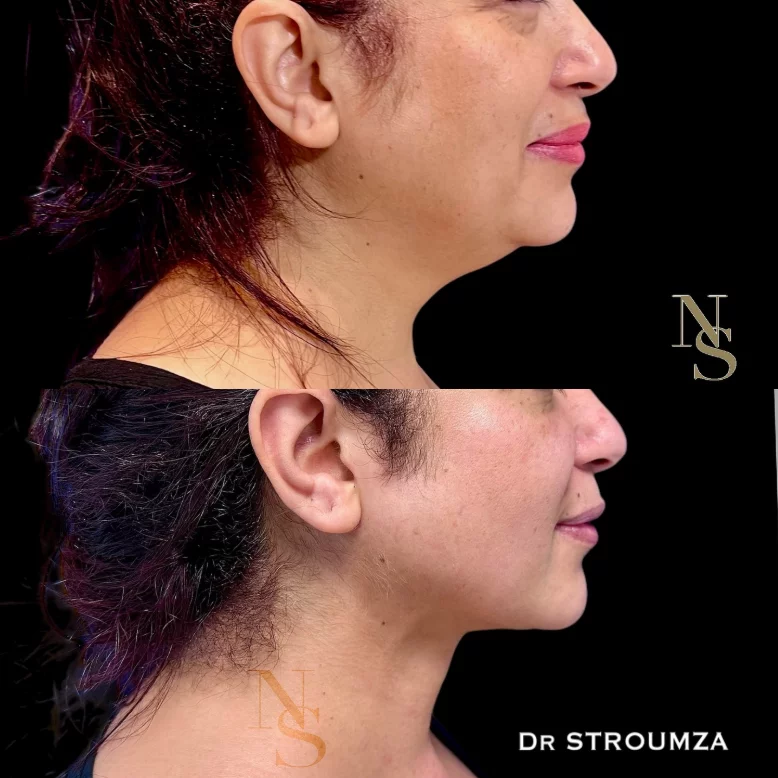 lifting du visage sans cicatrice