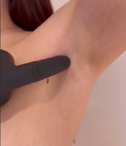 augmentation mammaire mini-invasive sans cicatrice visible