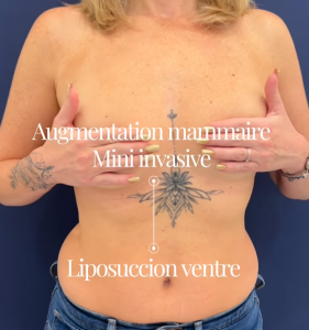 Une approche globale pour sublimer la silhouette L’association de la liposuccion abdominale et de l’augmentation mammaire mini-invasive vise à restaurer l’équilibre du corps. L’objectif n’est pas seulement d’affiner, mais aussi de réharmoniser les volumes pour un résultat naturel et féminin. En une seule intervention, il est possible de sculpter l’abdomen, d’alléger la taille et de redonner du galbe à la poitrine, tout en respectant la morphologie et la ligne naturelle du corps. La liposuccion abdominale : précision et finesse La liposuccion abdominale consiste à retirer l’excès de graisse localisée à l’aide de micro-canules fines. Cette technique, aujourd’hui miniaturisée, permet d’obtenir un ventre plus plat et une taille redessinée, sans cicatrice visible. Les gestes sont précis, limitant les ecchymoses et favorisant une récupération rapide. L’intervention se réalise le plus souvent sous anesthésie locale assistée, et les résultats s’améliorent progressivement dans les semaines suivant la chirurgie. L’augmentation mammaire mini-invasive : naturel et discrétion L’augmentation mammaire mini-invasive s’effectue à travers une micro-incision de 2 cm, dissimulée dans le pli sous-mammaire. Grâce à la technique « No Touch », l’implant est inséré sans contact avec la peau, garantissant une stérilité optimale et un placement précis. Cette approche réduit la douleur post-opératoire, évite toute cicatrice visible sur le sein et assure un résultat harmonieux et naturel. Les bénéfices d’une double intervention maîtrisée Associer la liposuccion et l’augmentation mammaire mini-invasive permet : 🔹 Une transformation globale du corps en une seule opération 🔹 Un temps de récupération réduit 🔹 Des résultats naturels et équilibrés 🔹 Une meilleure confiance en soi, grâce à une silhouette harmonieuse Chaque geste est pensé pour préserver les tissus et optimiser la sécurité et la précision du résultat. Une chirurgie de haute définition au service de la beauté naturelle Le Dr Stroumza pratique des techniques dites de « Haute Définition », qui associent précision chirurgicale et respect des formes naturelles. Loin des excès, cette approche vise à sublimer sans transformer, en respectant la singularité de chaque patiente. FAQ – Liposuccion et augmentation mammaire mini-invasive Est-il possible de combiner ces deux interventions le même jour ? Oui, dans de nombreux cas, ces interventions peuvent être associées pour un résultat harmonieux, sous anesthésie locale ou légère selon le profil de la patiente. Quel est le temps de récupération ? La plupart des patientes reprennent une activité légère après quelques jours. Le résultat définitif est visible après quelques semaines. Les cicatrices sont-elles visibles ? Non, les incisions sont de très petite taille et soigneusement dissimulées dans les plis naturels de la peau.