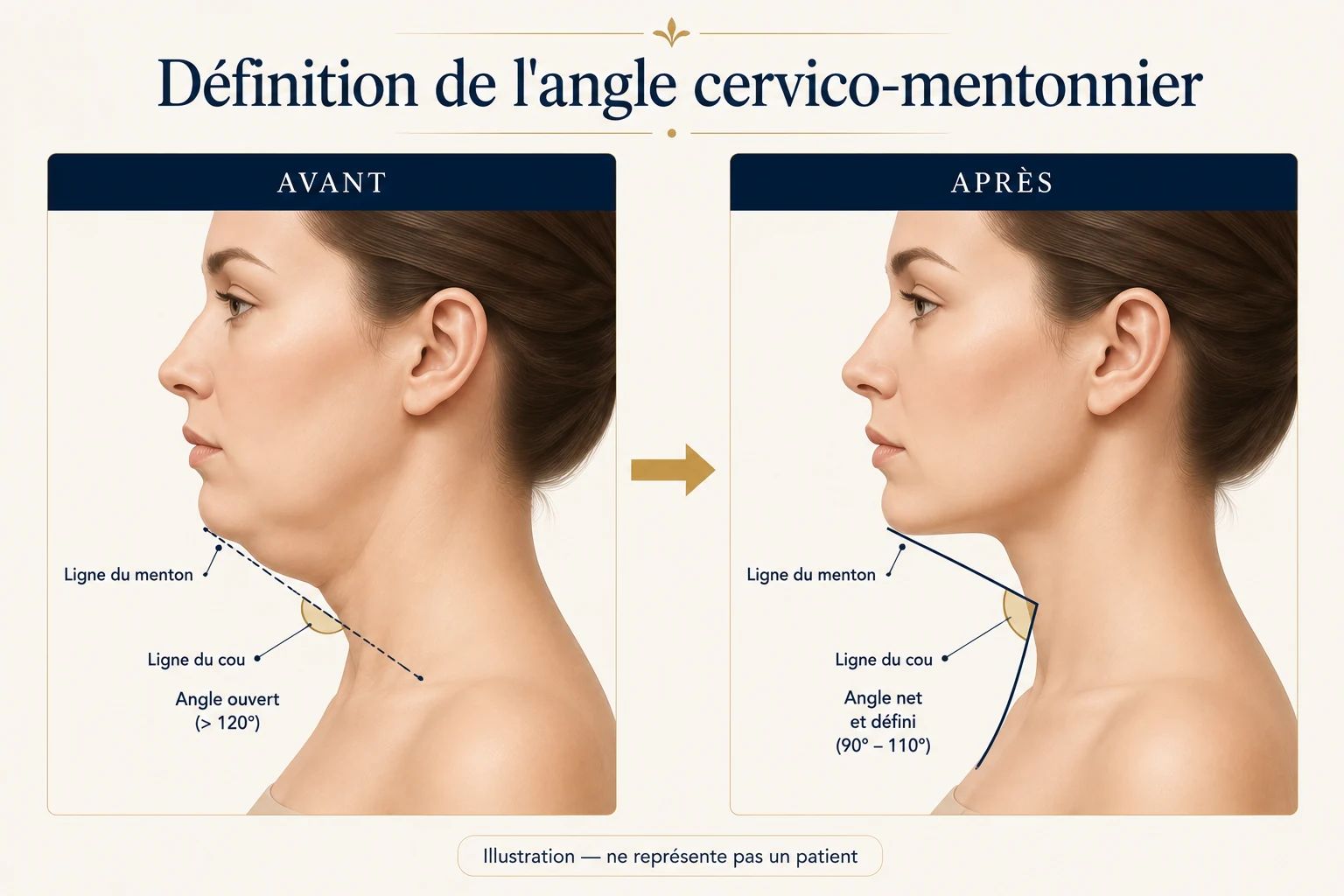 Angle cervico-mentonnier avant et après traitement du double menton : d’un angle ouvert à un angle net et défini — illustration, Dr Stroumza-Escoffier, Paris