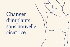 Illustration : changement d’implants mammaires par la cicatrice axillaire, sans nouvelle cicatrice sur le sein — Dr Stroumza-Escoffier, Paris