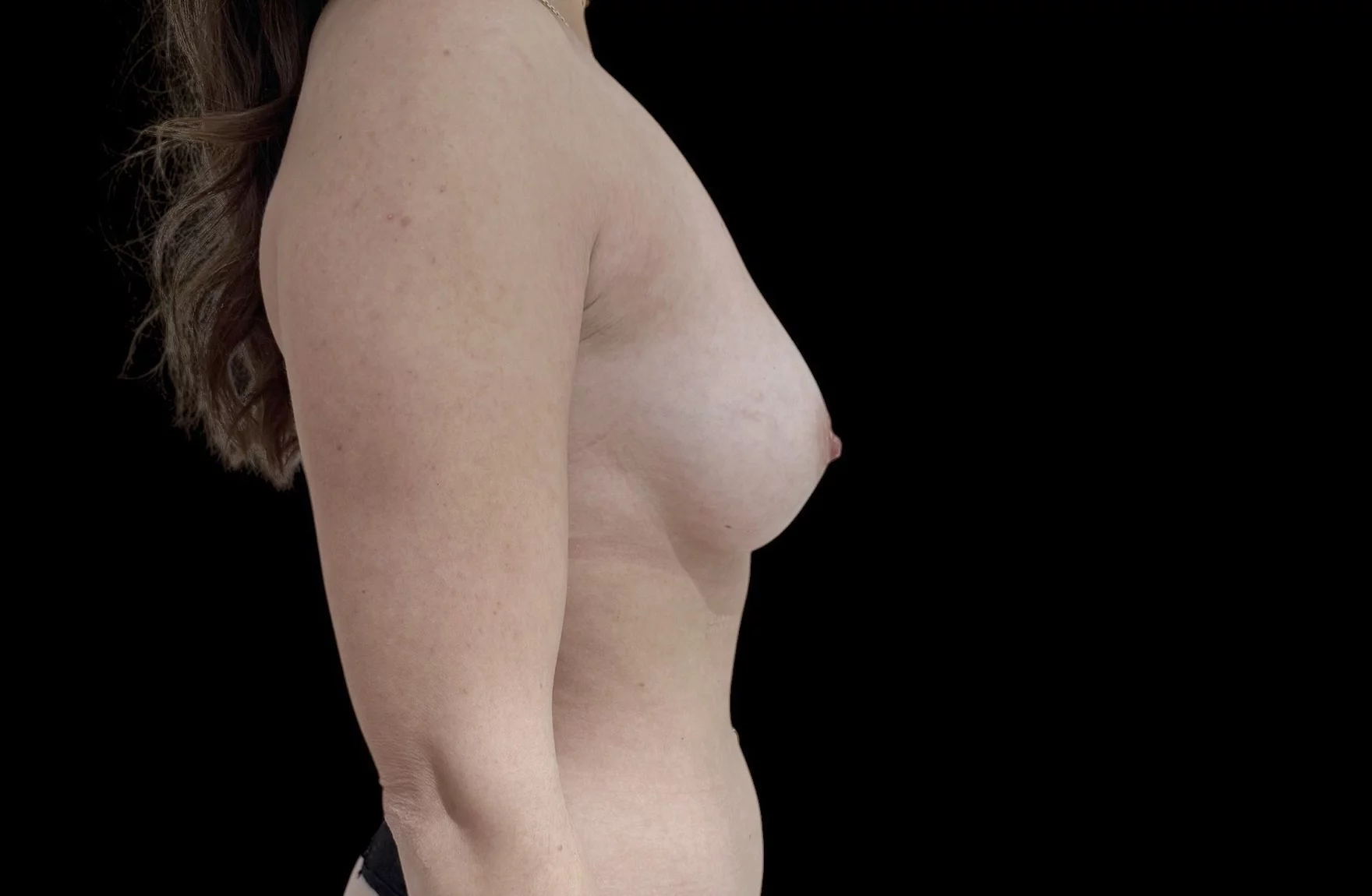 Cas 3 — correction d'asymétrie mammaire par voie axillaire, femme 40 ans, implants 190 et 170 cc, vue de profil après intervention, recul 3 ans