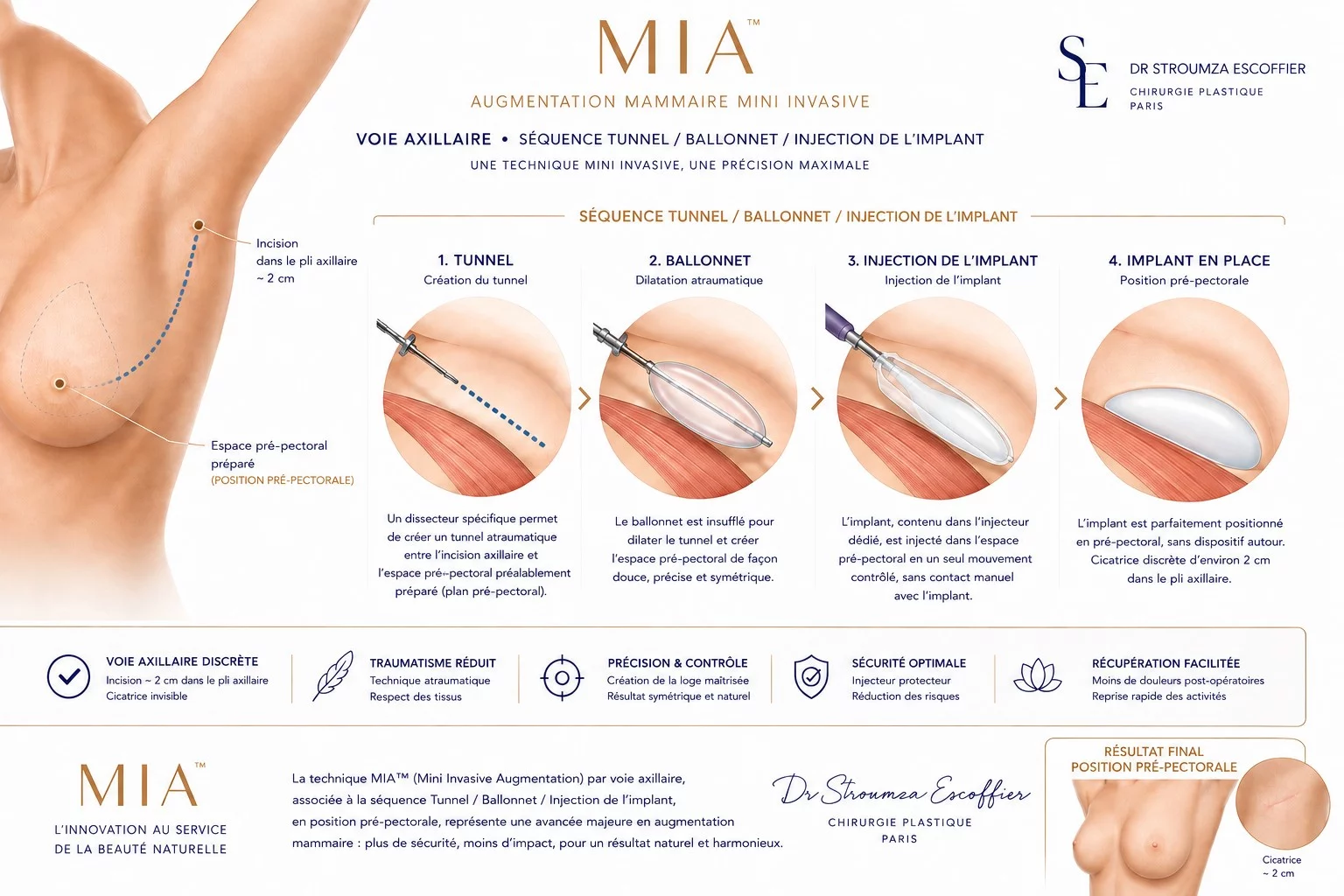 Augmentation mammaire mini-invasive par voie axillaire — schéma des quatre étapes : tunnel, ballonnet, injection de l'implant, position pré-pectorale. Dr Stroumza-Escoffier, Paris