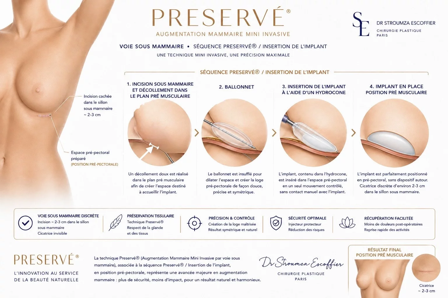 Augmentation mammaire mini-invasive par voie sous-mammaire — schéma des quatre étapes : incision et décollement pré-musculaire, ballonnet, insertion par hydrocône, position pré-pectorale. Dr Stroumza-Escoffier, Paris