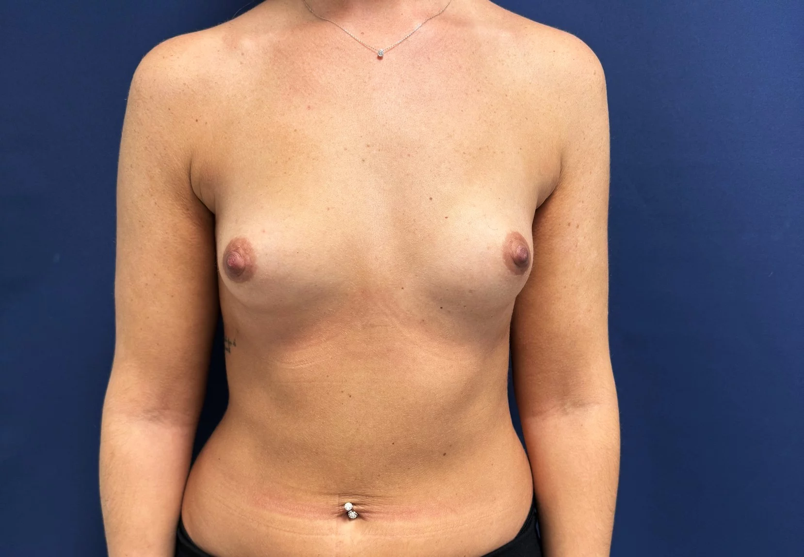 Cas 4 — augmentation mammaire mini-invasive par voie sous-mammaire, vue de face avant intervention — Dr Stroumza-Escoffier, Paris