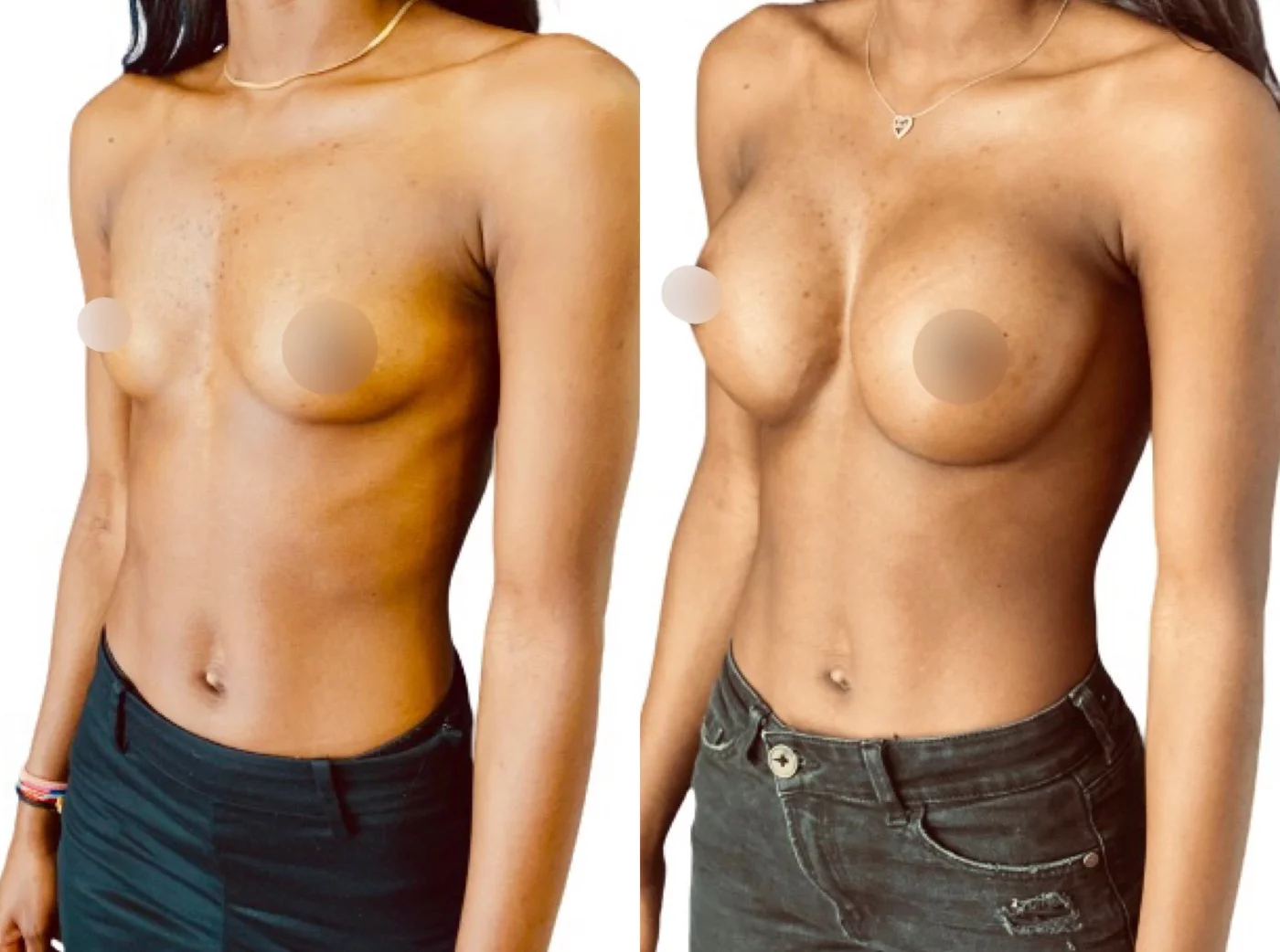 Cas 5 — augmentation mammaire mini-invasive par voie sous-mammaire, vue de trois-quarts avant et après intervention