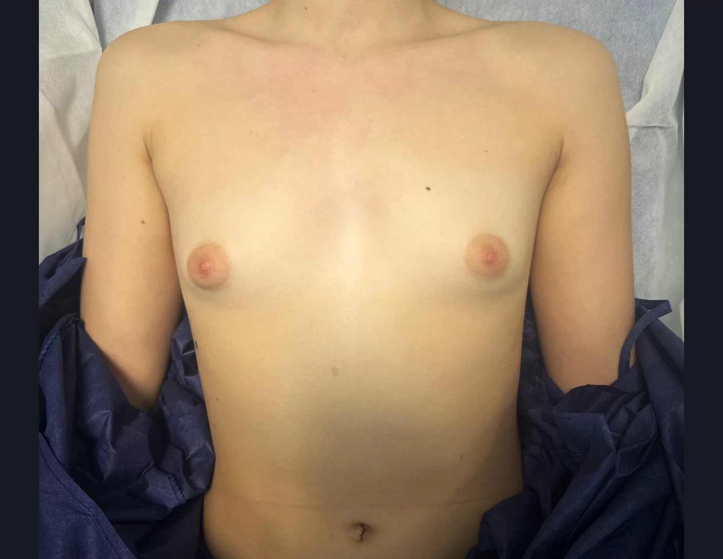 Cas 6 — augmentation mammaire mini-invasive par voie sous-mammaire, vue de face avant intervention — Dr Stroumza-Escoffier, Paris
