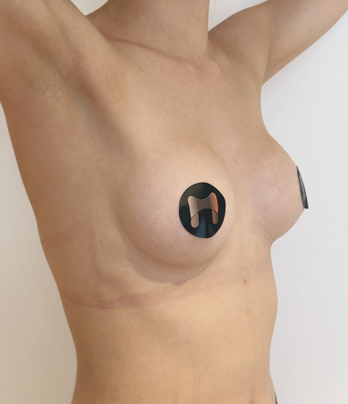 Augmentation mammaire par voie axillaire — absence de cicatrice sur le sein, Dr Stroumza-Escoffier, Paris