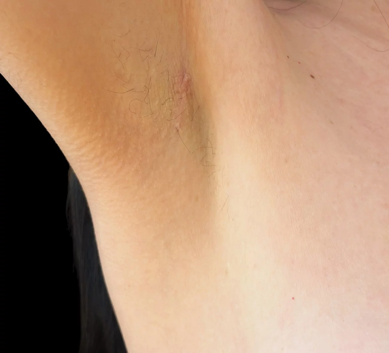 Cicatrice d'augmentation mammaire par voie axillaire à distance de l'intervention — Dr Stroumza-Escoffier, Paris
