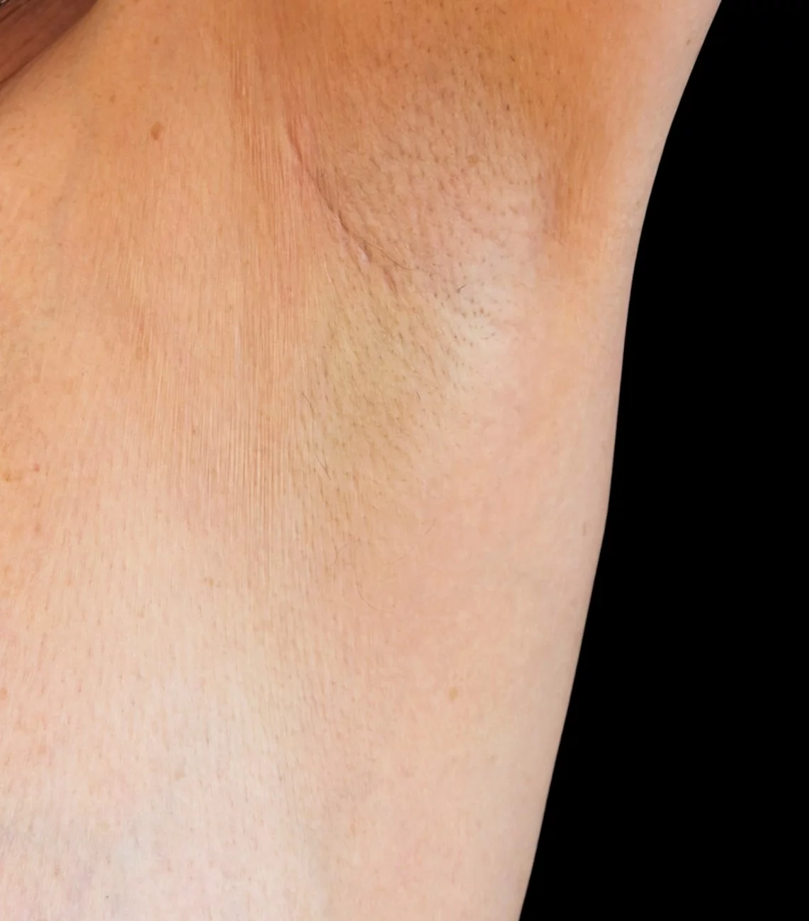 Cicatrice d'augmentation mammaire par voie axillaire à distance de l'intervention — Dr Stroumza-Escoffier, Paris