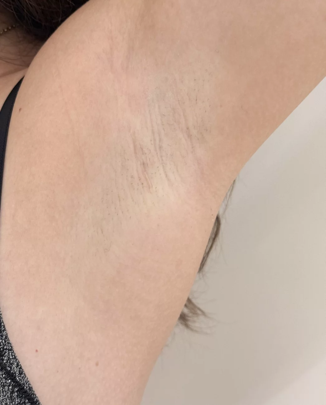 Cicatrice d'augmentation mammaire par voie axillaire à distance de l'intervention — Dr Stroumza-Escoffier, Paris