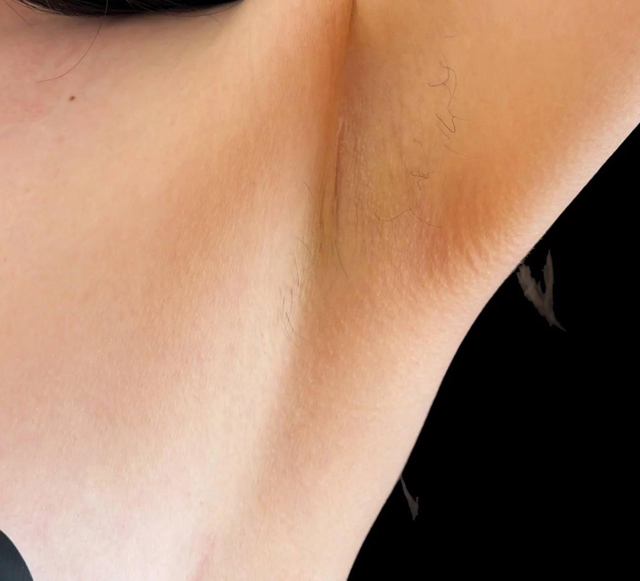 Cicatrice d'augmentation mammaire par voie axillaire à distance de l'intervention — Dr Stroumza-Escoffier, Paris