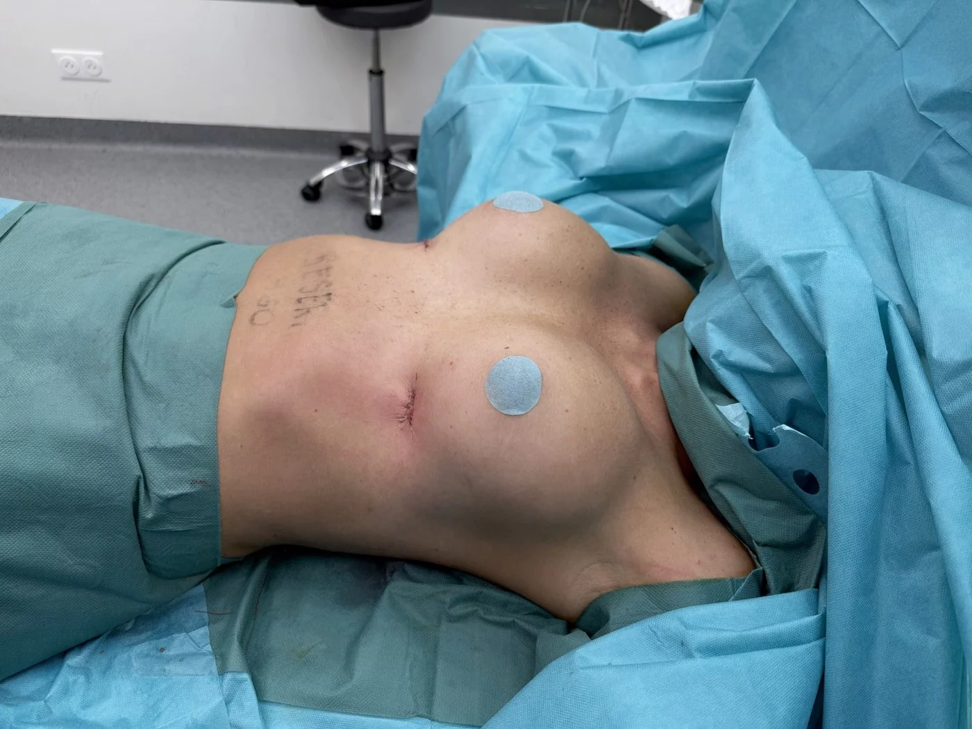 Incision sous-mammaire suturée en fin d'intervention, augmentation mammaire mini-invasive — Dr Stroumza-Escoffier, Paris