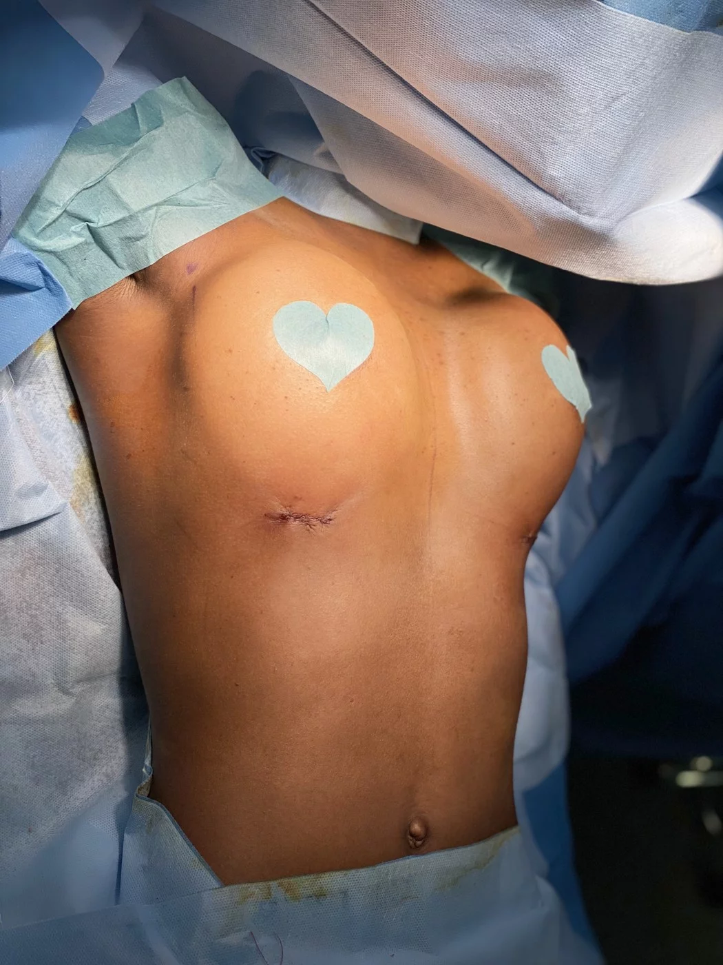 Incision sous-mammaire suturée en fin d'intervention, augmentation mammaire mini-invasive — Dr Stroumza-Escoffier, Paris