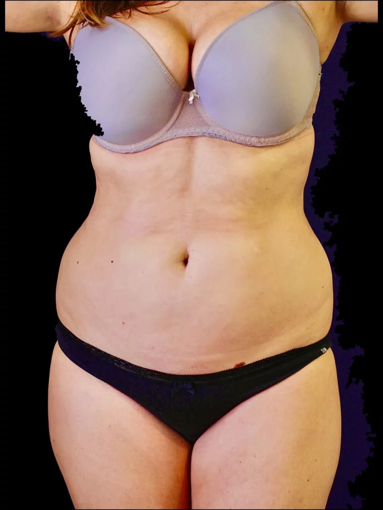 Liposuccion du ventre haute définition 360° avant intervention — femme de 30 ans, vue de face — Dr Stroumza-Escoffier, Paris