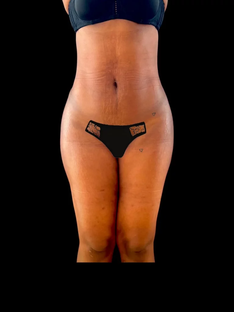 Résultat à 12 mois — femme de 38 ans, vue de face, après lipoaspiration multi-zones, lipofilling fesses et hanches et radiofréquence — Dr Stroumza-Escoffier, Paris