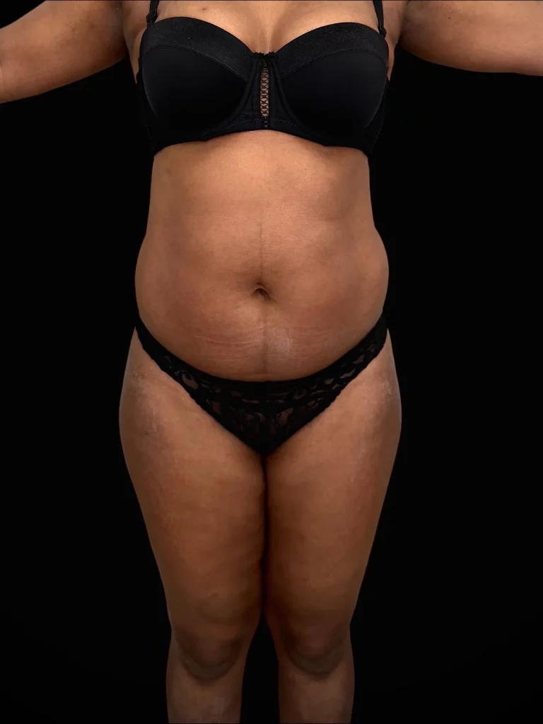 Remodelage multi-zones avant intervention — femme de 38 ans, vue de face, avant lipoaspiration de l'abdomen, des cuisses et des bras avec lipofilling fesses et hanches — Dr Stroumza-Escoffier, Paris