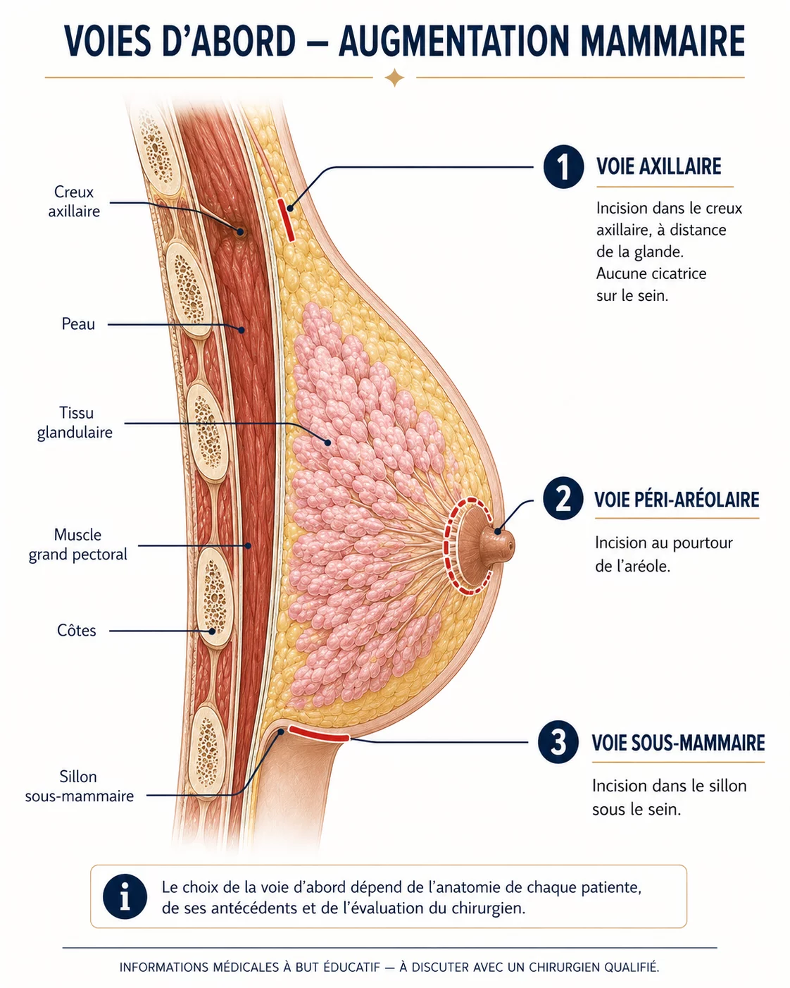 Schéma en coupe du sein montrant les trois voies d’abord de l’augmentation mammaire : voie axillaire, voie péri-aréolaire et voie sous-mammaire — Dr Stroumza-Escoffier, Paris