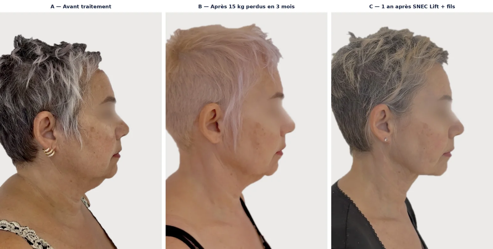 Profil d’une patiente de 63 ans avant traitement, après 15 kg perdus sous analogue du GLP-1, puis un an après SNEC Lift et fils tenseurs